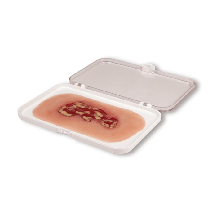 Moulage de plaie Ulcus Cruris Venosum, petit, phase d'exsudation