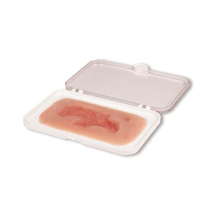 [PW002C] Moulage de plaie ulcère de jambe veineux, petit, phase d'épithélisation